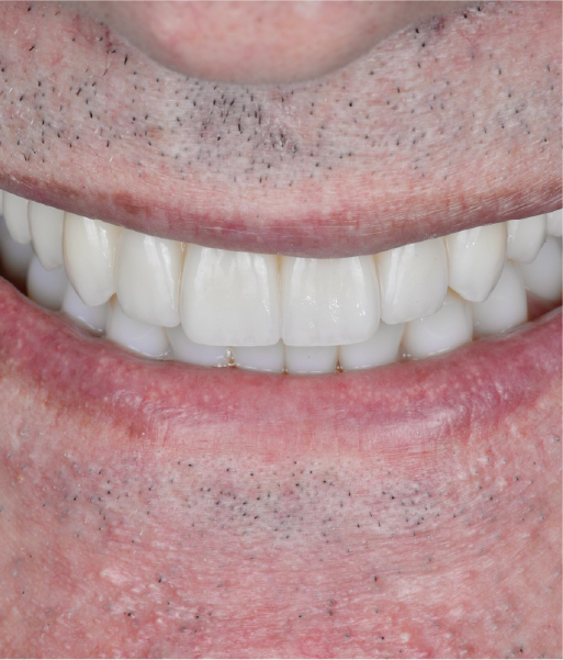 Zirconia monolítica